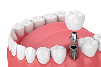 dental implant being placed in a patient’s lower jaw 