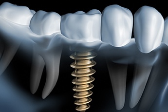 X-ray of a patient with a dental implant 