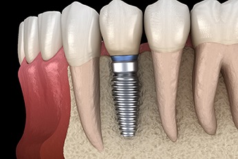 Diagram of an integrated dental implant in Manchester