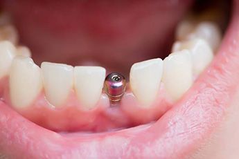 Dental Implants from Celeb Jaws Health