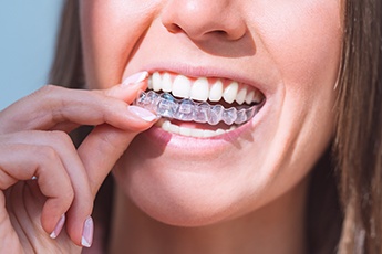 Invisalign has many benefits over traditional braces