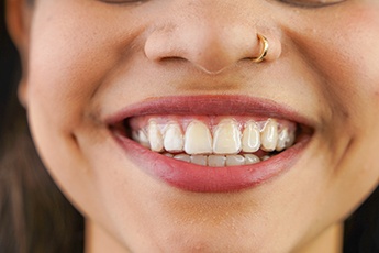 Invisalign treatment is more discreet so you can smile confidently