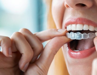 a person wearing their Invisalign aligners