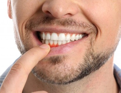 a man showing signs of gum disease