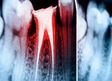 X-ray of an infected tooth