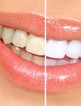 Closeup of patient's teeth before and after teeth whitening treatment