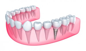 illustration of dental implant