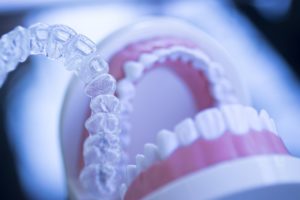 ClearCorrect aligners being placed on a model of a mouth