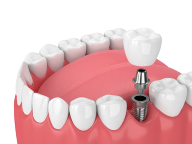 Illustration of dental implant in Manchester
