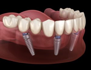 full denture on bottom arch retained by dental implants  