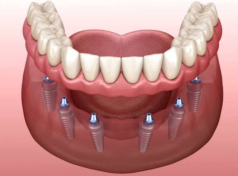 Diagram of an implant denture 