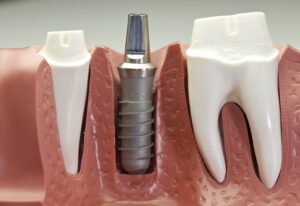Dental implant post replacing a root